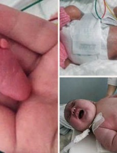 中国最小婴儿体重950克你敢想象吗，贵州产妇妊娠30周产下（婴儿仅巴掌大小）