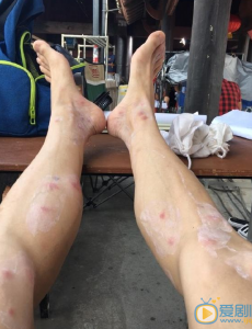 张一山剧组拍戏晒"蚊子包"腿部特写 戏称“我将中毒身亡，怀念我”